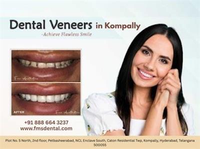 Dental Veneers in Kompally - FMS Dental