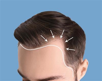 Hair Transplantation Treatment in Chennai