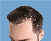 Hair Transplantation Treatment in Chennai