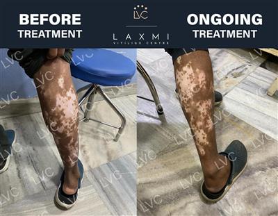 Reverse Vitiligo Naturally | Dr. Cheena