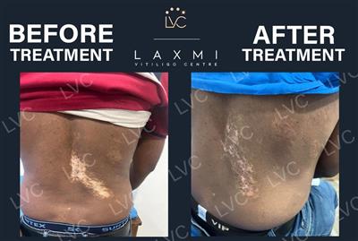 Reverse Vitiligo Naturally | Dr. Cheena