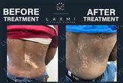 Reverse Vitiligo Naturally | Dr. Cheena