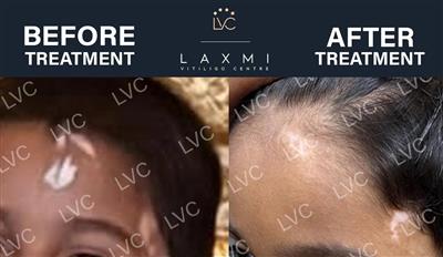 Reverse Vitiligo Naturally | Dr. Cheena