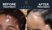 Reverse Vitiligo Naturally | Dr. Cheena