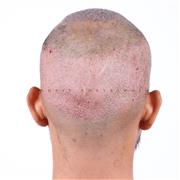 Hair Transplant in Indore – Advanced Solution for Permanent Hair Restoration
