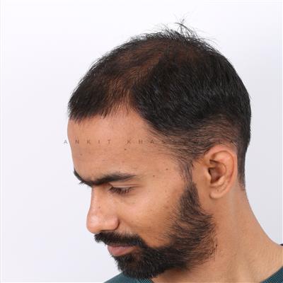 Hair Transplant in Indore – Advanced Solution for Permanent Hair Restoration