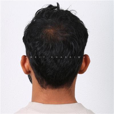 Hair Transplant in Indore – Advanced Solution for Permanent Hair Restoration