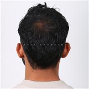 Hair Transplant in Indore – Advanced Solution for Permanent Hair Restoration