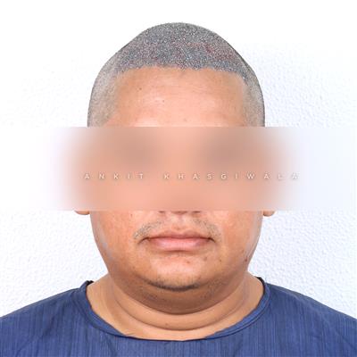 Hair Transplant in Indore – Advanced Solution for Permanent Hair Restoration