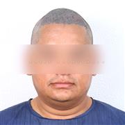Hair Transplant in Indore – Advanced Solution for Permanent Hair Restoration