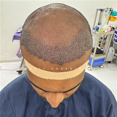 Hair Transplant in Indore – Advanced Solution for Permanent Hair Restoration