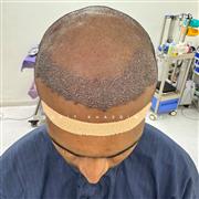 Hair Transplant in Indore – Advanced Solution for Permanent Hair Restoration