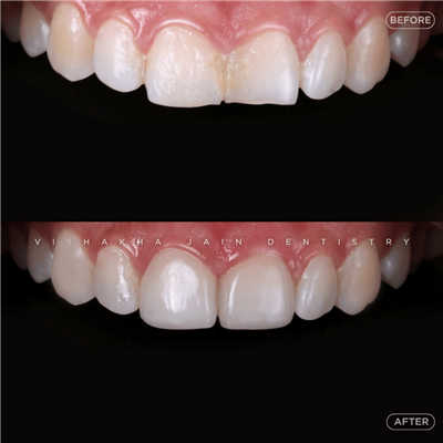 Dental Implant in Indore | Best Implant Treatment & Expert Dental Care