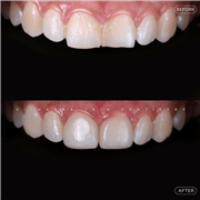 Dental Implant in Indore | Best Implant Treatment & Expert Dental Care
