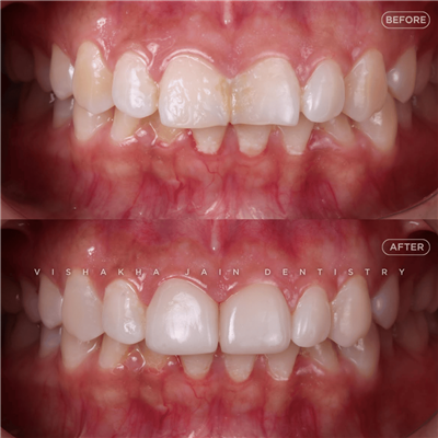 Dental Implant in Indore | Best Implant Treatment & Expert Dental Care