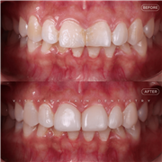 Dental Implant in Indore | Best Implant Treatment & Expert Dental Care