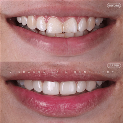 Dental Implant in Indore | Best Implant Treatment & Expert Dental Care