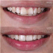 Dental Implant in Indore | Best Implant Treatment & Expert Dental Care