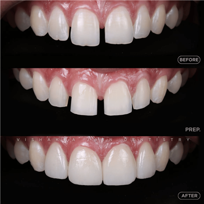 Dental Implant in Indore | Best Implant Treatment & Expert Dental Care