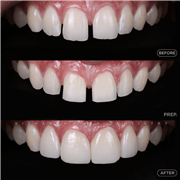 Dental Implant in Indore | Best Implant Treatment & Expert Dental Care