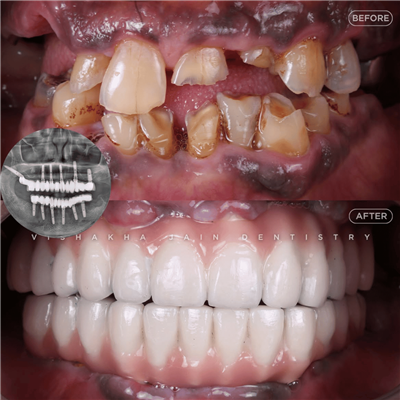 Dental Implant in Indore | Best Implant Treatment & Expert Dental Care
