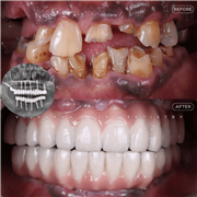 Dental Implant in Indore | Best Implant Treatment & Expert Dental Care