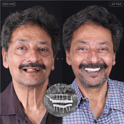 Dental Implant in Indore | Best Implant Treatment & Expert Dental Care
