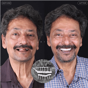 Dental Implant in Indore | Best Implant Treatment & Expert Dental Care