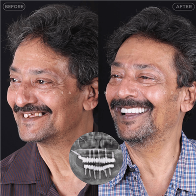 Dental Implant in Indore | Best Implant Treatment & Expert Dental Care