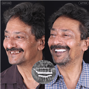 Dental Implant in Indore | Best Implant Treatment & Expert Dental Care
