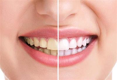 Best Dentist in Pune | Dentist in Kalyani Nagar | Dr. Thareja’s Dental Care