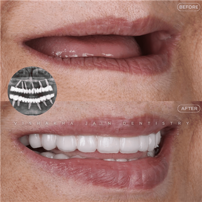Best Dental Clinic in Indore | Dental Implants & Smile Designing