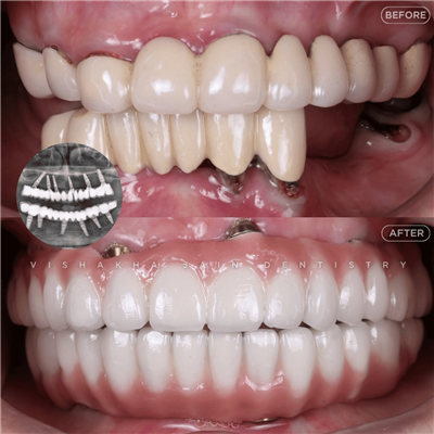 Best Dental Clinic in Indore | Dental Implants & Smile Designing