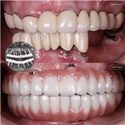Best Dental Clinic in Indore | Dental Implants & Smile Designing